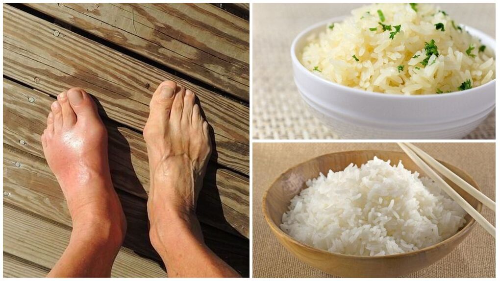 痛風患者には米ベースの食事が推奨されます。
